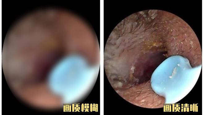 吗？挖耳勺到底怎么选？十大品牌测评分享！